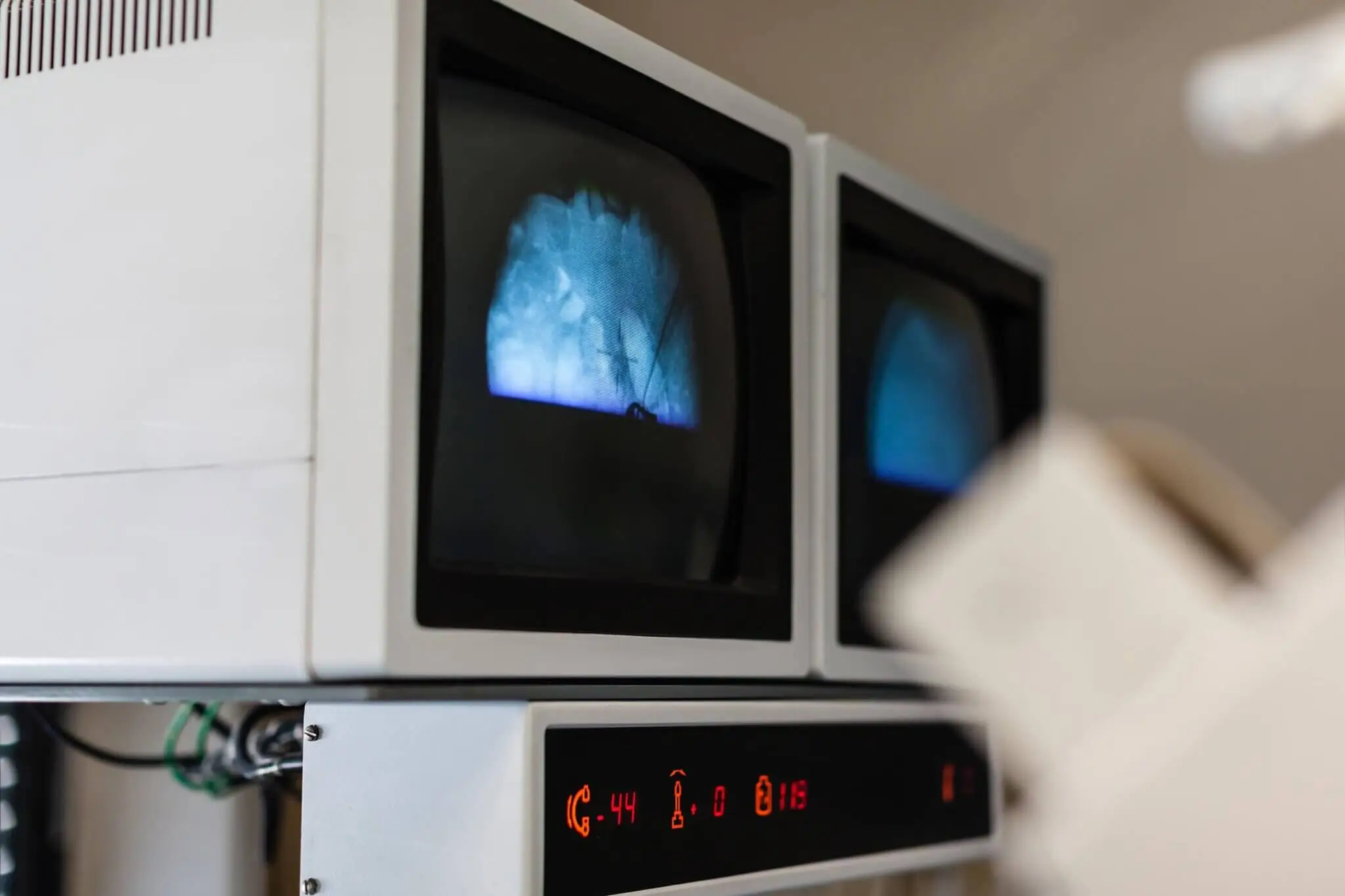 Διουρηθρική Laser Κυστεολιθοτριψία