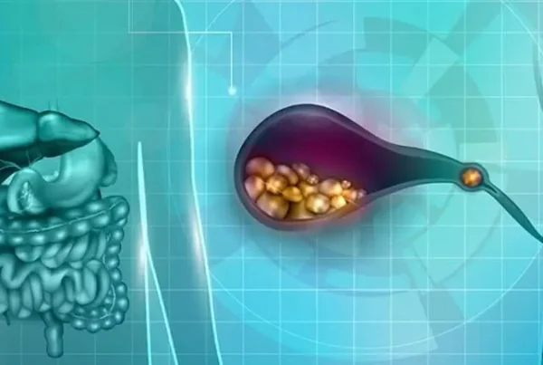 Πέτρες στη χολή