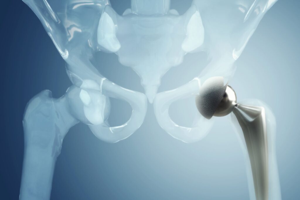 πόνος μετά από αρθροπλαστική ισχίου