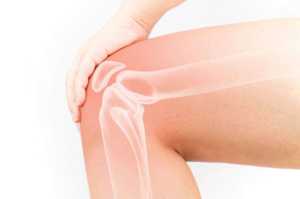 πρησμένο γόνατο μετά από αρθροπλαστική